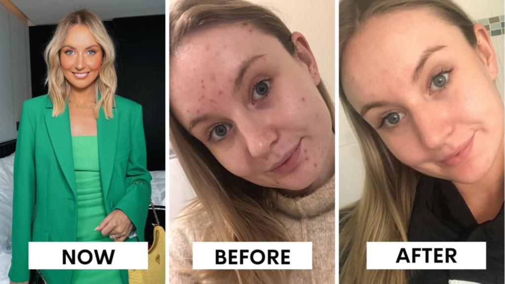 How Aussie’s acne battle sparked multi-million dollar ‘miracle’ skincare brand