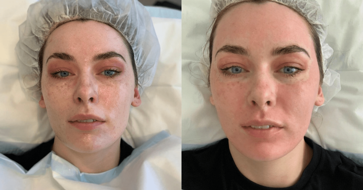 ROADTEST: ‘I got Fraxel laser treatment to fade my freckles. Here’s exactly what happened.’